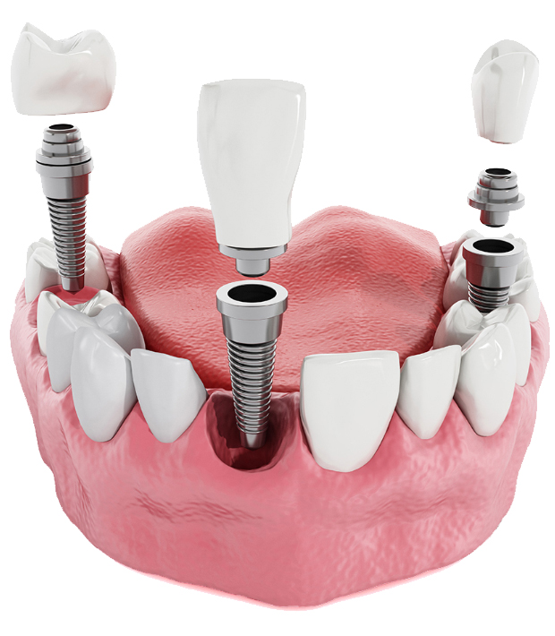Dental implants are making the world smile a little bigger.