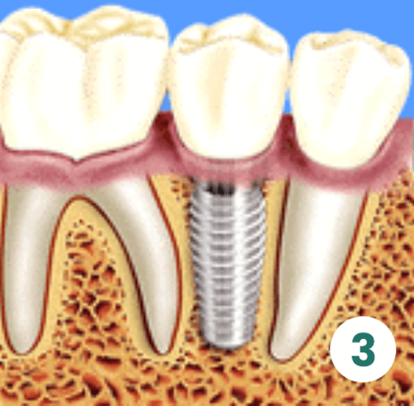 Dental Implants cost in Mexico Dental Implants Center Tijuana